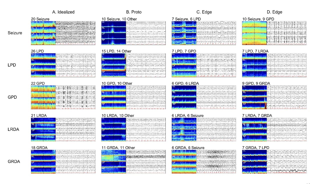 Kaggle competition image for HMS - Harmful Brain Activity Classification