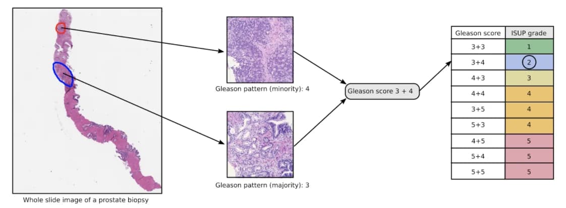 Kaggle competition image for Prostate cANcer graDe Assessment (PANDA) Challenge