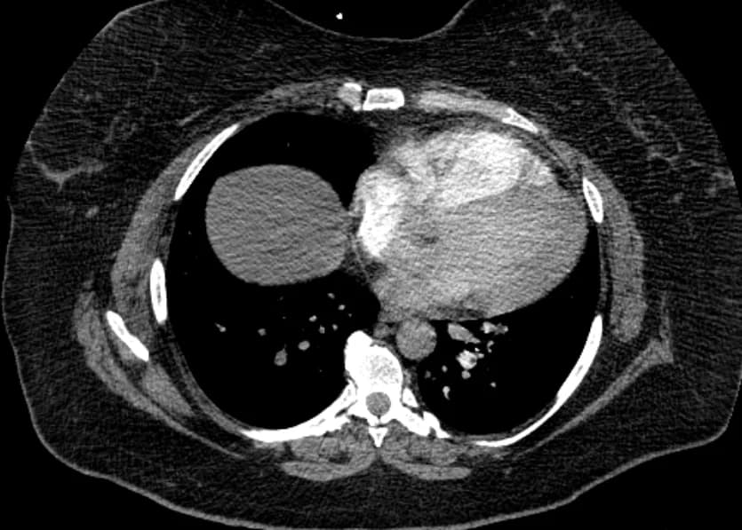 Kaggle competition image for RSNA STR Pulmonary Embolism Detection